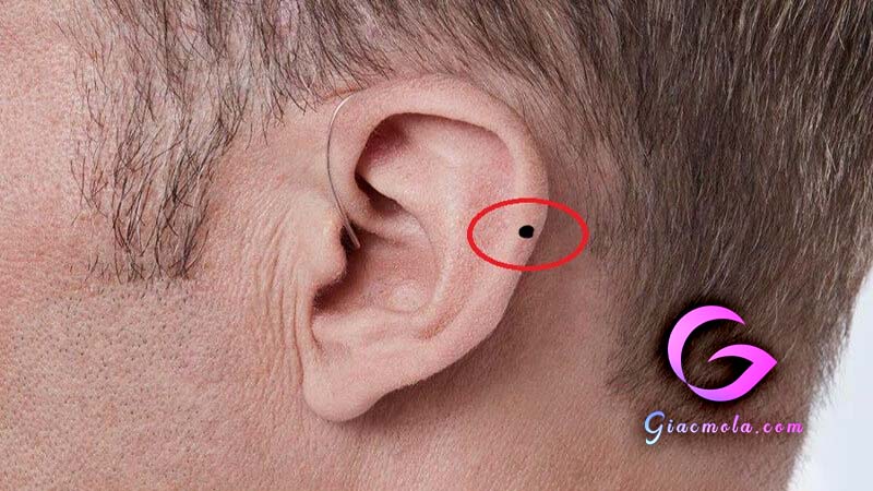Nốt ruồi xuất hiện ở vành tai